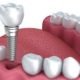 dental implants in Ahmedabad